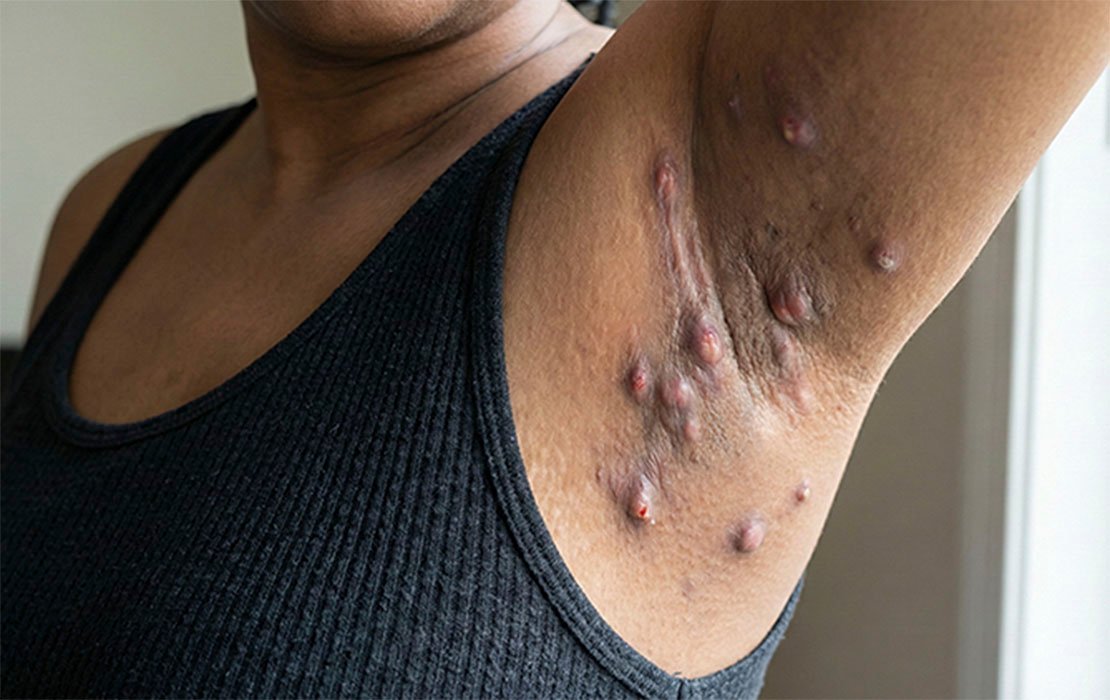 Hidrosadenitis supurativa